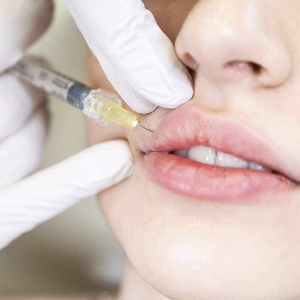 Russian lips 1 classic lips filler Dungannon